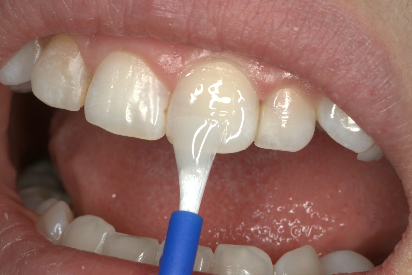 A tooth is painted with varnish